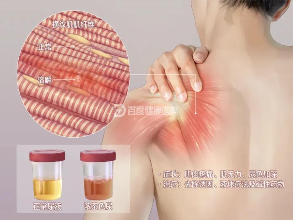 开云体育下载-警惕!小心这些药正在“溶解”你的肌肉